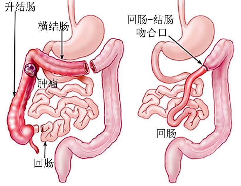 结肠癌常见的手术方式有哪些？