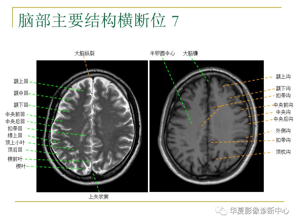 中国人脑立体定向mri应用解剖图谱,脑mri示意图