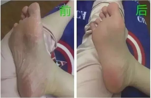 冬季皲裂膏预防脚后跟干裂好用的,上热门脚后跟干裂保湿霜