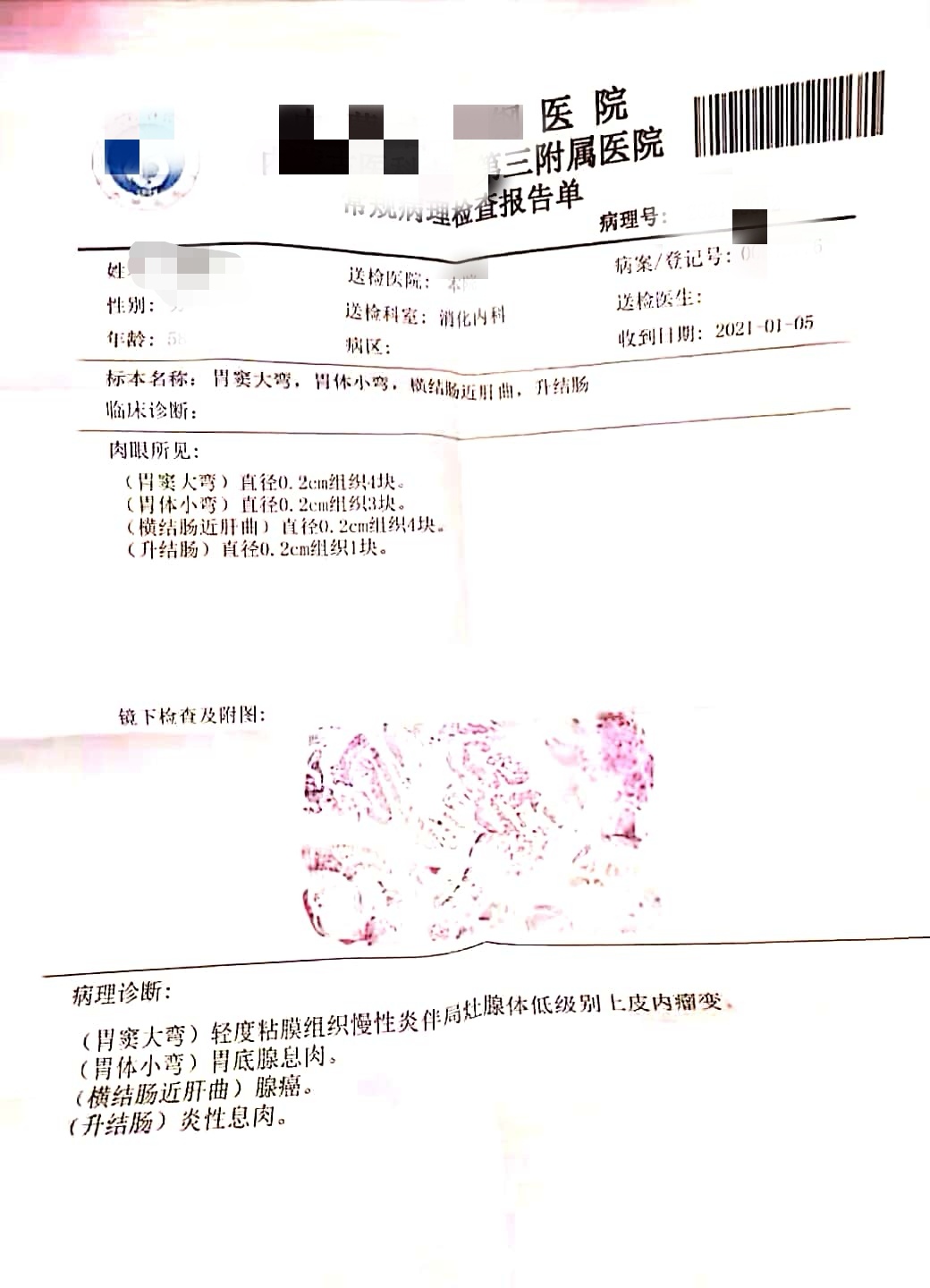 结肠癌患者会遗传直肠癌吗,结肠癌会遗传给子女吗