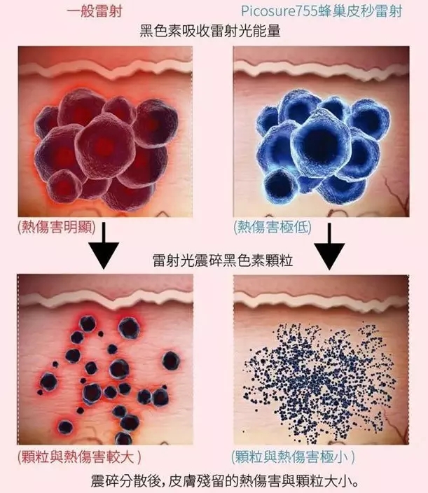 褐斑的原因及治疗方法,褐斑的原因和治疗方法