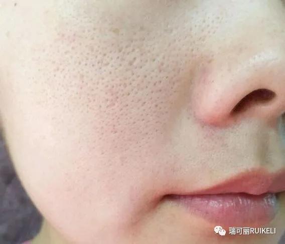 怎样让粗大的毛孔减少,毛孔变黑且粗大怎么治