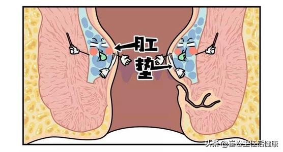 大便出血疼痛是癌症吗,直肠癌和痔疮大便出血的区别