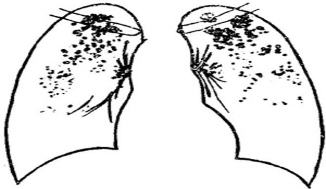 结核病人的脸色什么颜色,结核病人脸色好看吗