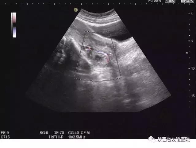 孕妇超声检查不良影响,孕妇超声检查的几大误区