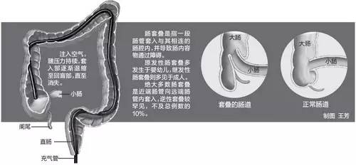 恐怖的肠套叠经历！抓住救命黄金12小时