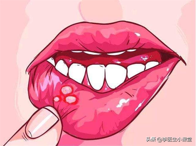 长口腔溃疡一般都是缺哪些维生素,口腔溃疡和长倒刺是缺乏什么