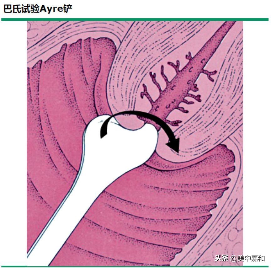 tct和hpv哪个对宫颈癌检测更准确,防宫颈癌检查hpv还是tct
