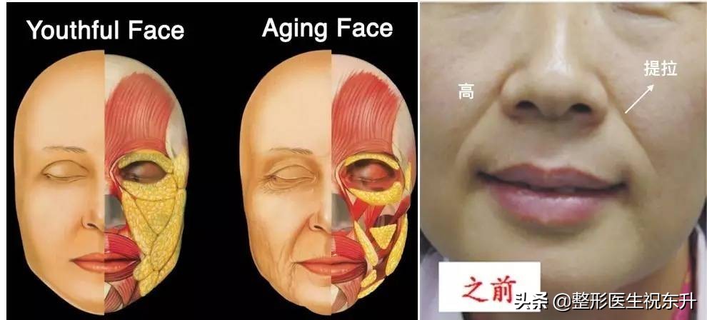 终于知道法令纹怎么来的了,关于法令纹的误解