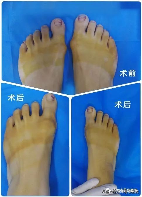 大脚骨会带来哪些危害,割大脚骨的危害