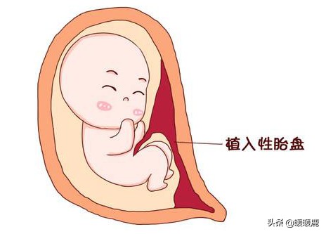 前壁胎盘和前置胎盘有什么区别,前壁胎盘和前置胎盘的区别有哪些