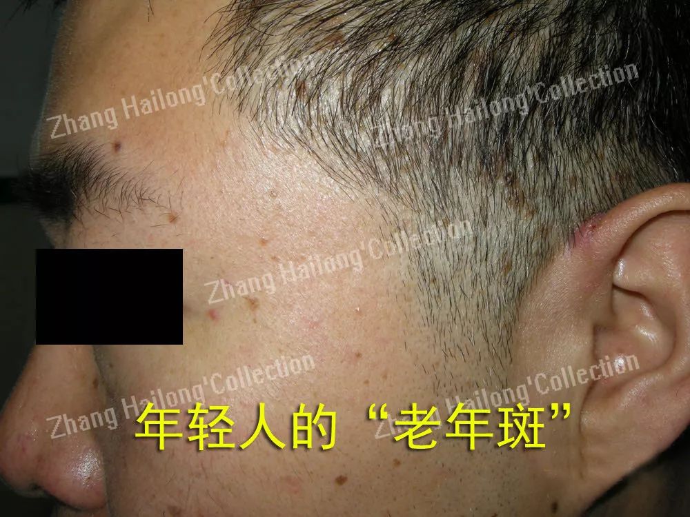 Ohno！老妈脸上出现了老年斑...