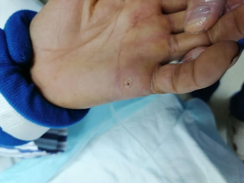 锈的铁器划破了手指会破伤风吗,被带铁锈的小刀划伤会有破伤风吗