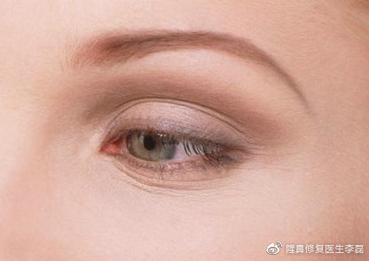 眼周细纹能整形解决吗,眼周皱纹很深怎么整形修复