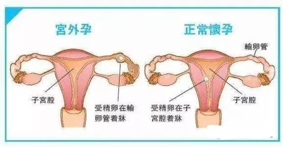 宫外孕你了解吗,带你了解子宫内膜异位症