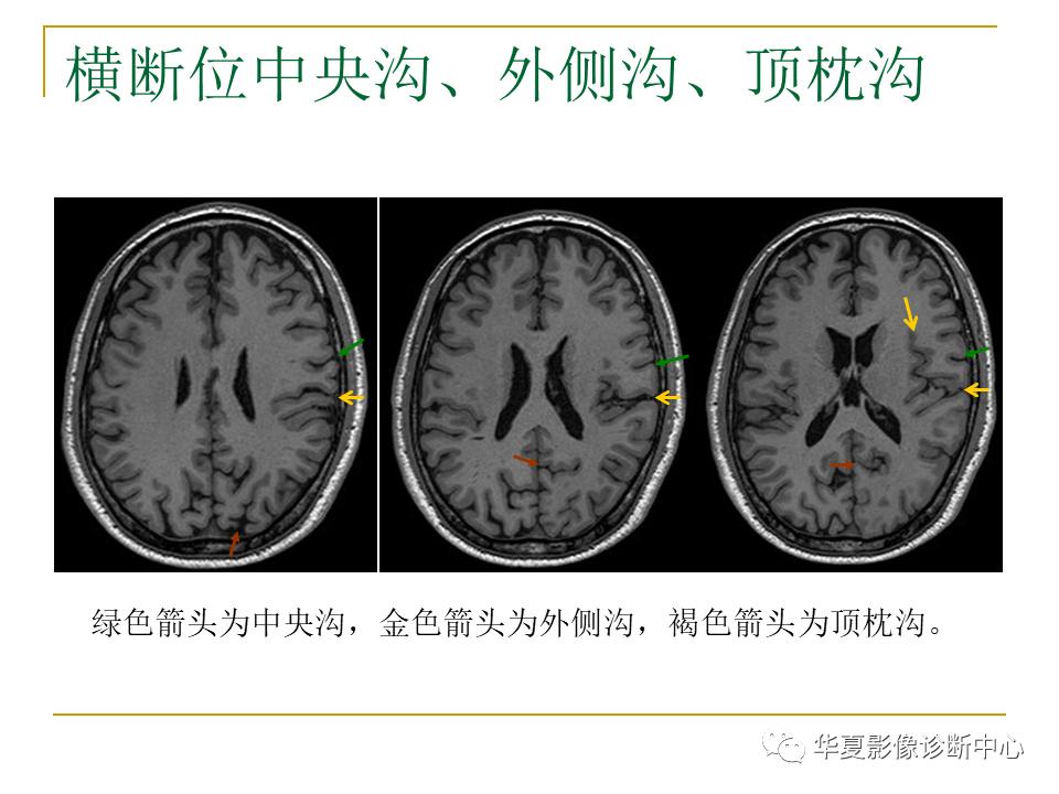 中国人脑立体定向mri应用解剖图谱,脑mri示意图