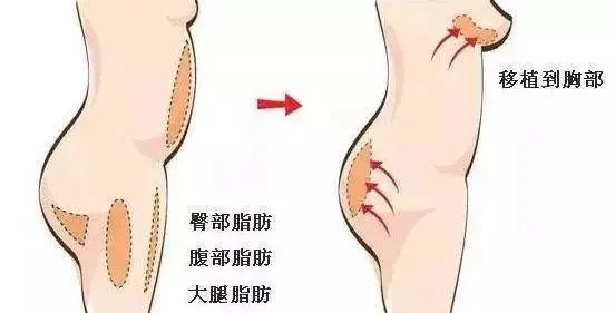 自体脂肪隆胸两年后的忠告,平胸可以做自体脂肪隆胸吗