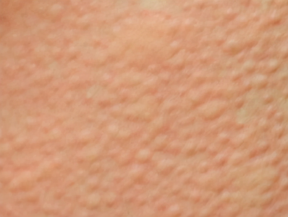 荨麻疹缓解瘙痒的方法是什么,荨麻疹瘙痒难忍可以用什么缓解