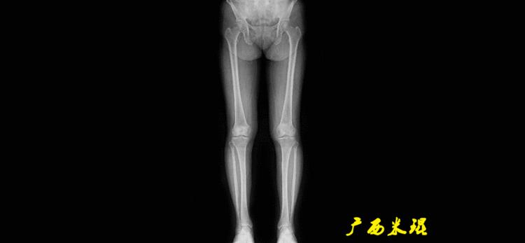 广西骨科医生米琨最新信息,米琨广西骨科什么水平