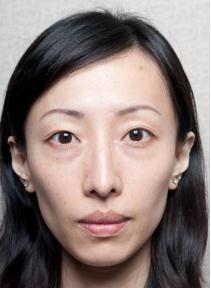 打溶脂针和瘦脸针哪个副作用大,打瘦脸针有没有副作用和后遗症