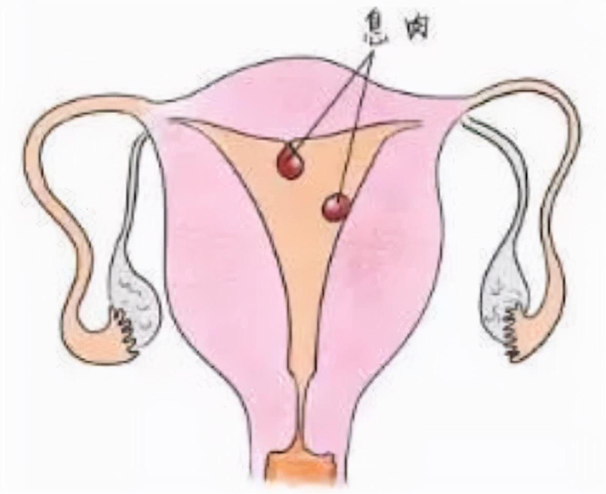 原发性不孕检查出内膜息肉,内膜息肉中医调养备孕