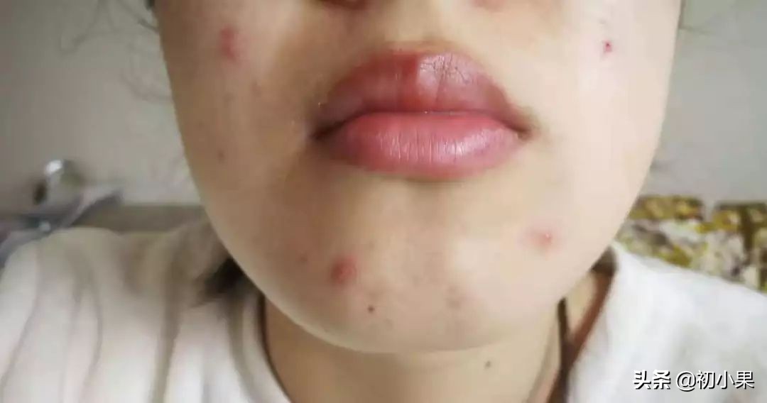 居家旅行必备的战痘攻略