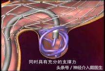 脑血管支架植入术适应症及禁忌症,脑血管介入取栓下支架后出血