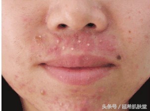 下巴长满痘痘是什么原因怎么调理,下巴不停冒脓包型痘痘怎么样调理