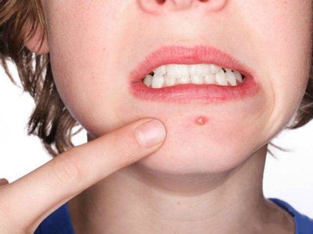 长痘内调吃什么蔬菜水果,长痘吃什么粥