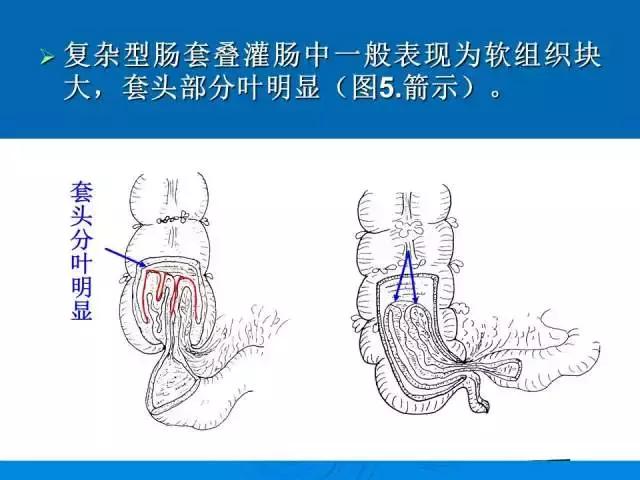 儿童肠套叠空气灌肠后遗症,儿童肠套叠空气灌肠复发几率高吗