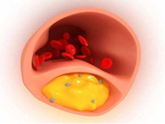 甘油三酯高为什么会导致动脉硬化,动脉硬化指数和甘油三酯高吃什么