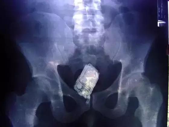 盘点X光透视下的人体异物，看着都痛！