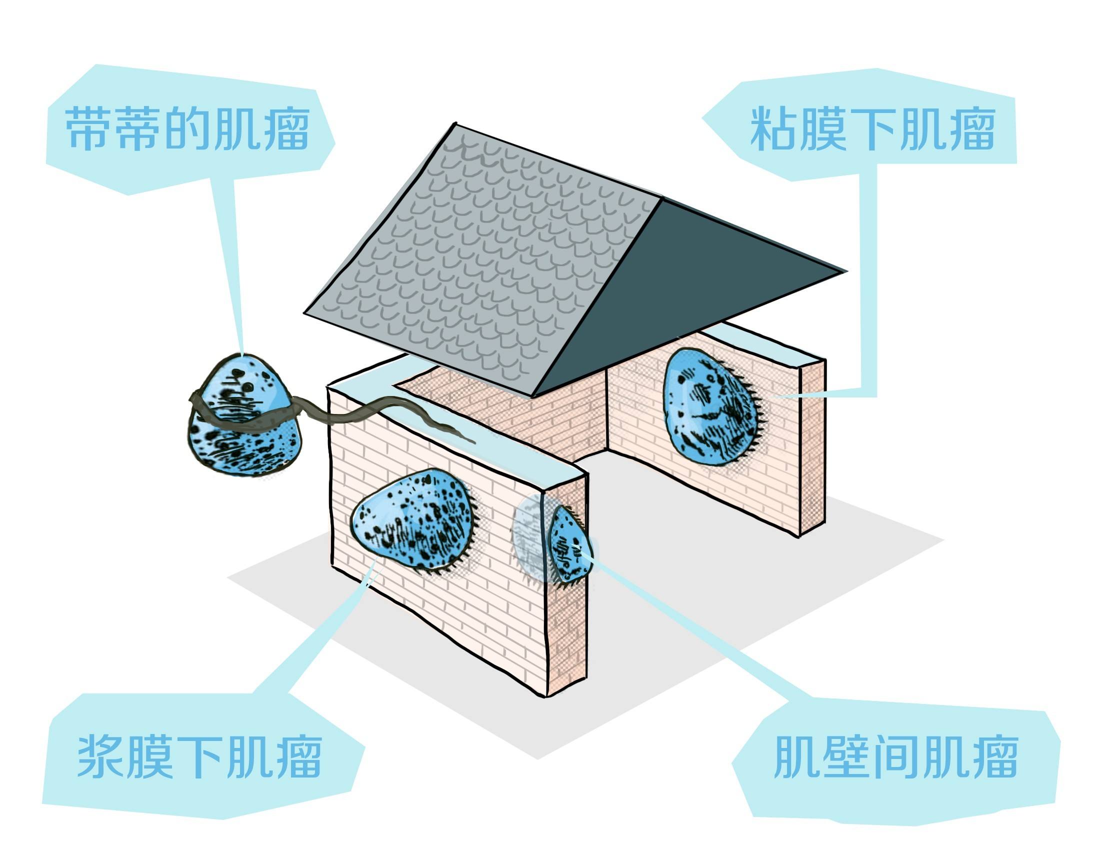 巨大子宫肌瘤手术取出3斤,罕见医生从女子胆囊取出巨大结石