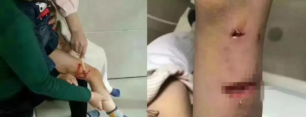 如果孩子被狗追咬该怎么办,小孩被家狗咬了几天才知道怎么办