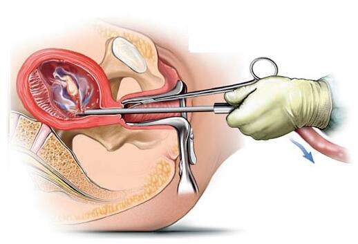 药流再清宫伤害小还是直接人流小,药流不干净清宫和人流哪个伤害大