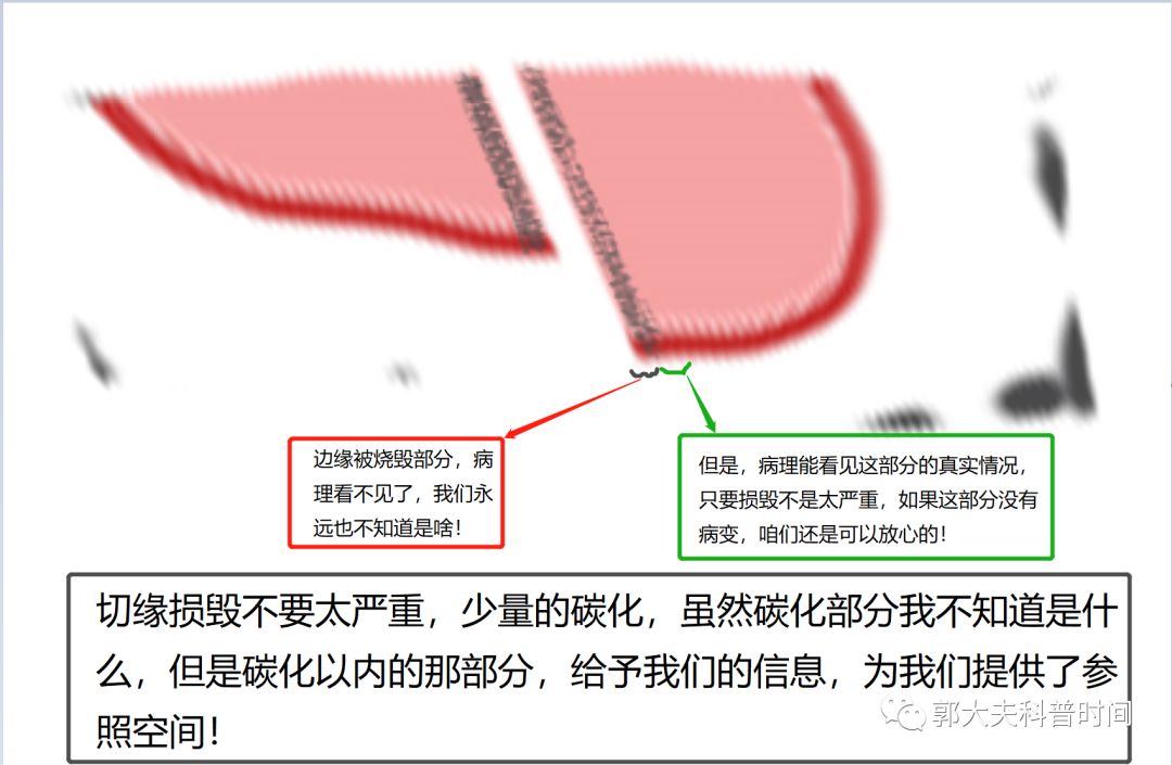 leep手术和激光手术有什么区别,leep手术的好处与坏处