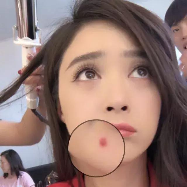 困扰好几年的痘痘终于好了,困扰多年痘痘终于好了