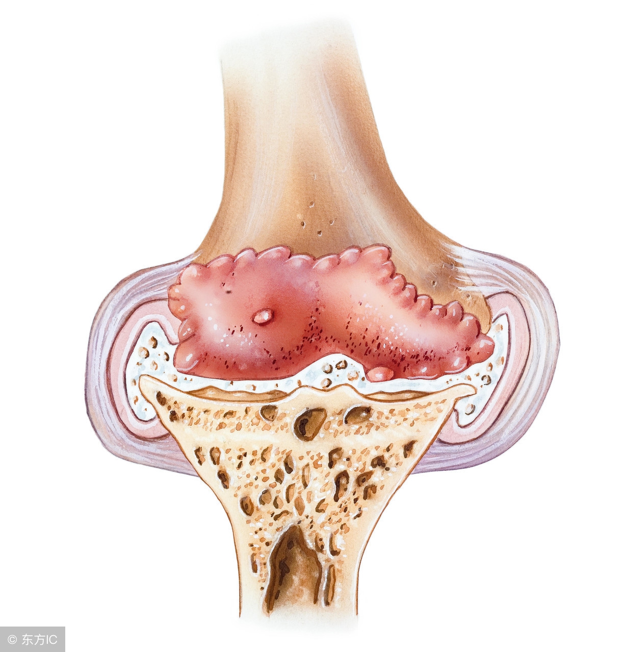 骨刺贴治骨刺的膏药管用吗,骨刺的最佳治疗有膏药贴吗