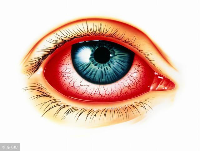 孩子得了结膜炎的图片,得了过敏性结膜炎该注意什么