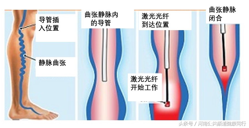 静脉曲张郑大一附院看哪个科,郑大一附院硬化剂治疗静脉曲张
