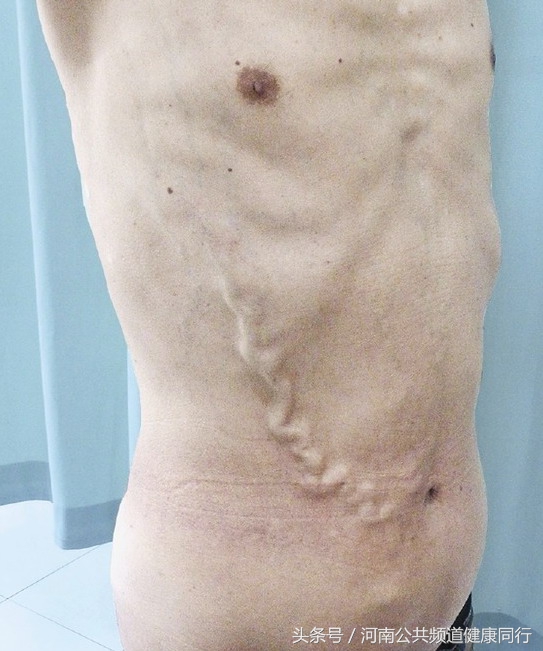 静脉曲张郑大一附院看哪个科,郑大一附院硬化剂治疗静脉曲张