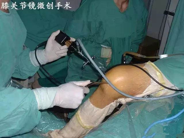 膝盖受凉滑膜炎用什么膏药,生姜土豆治膝盖积液肿胀滑膜炎吗