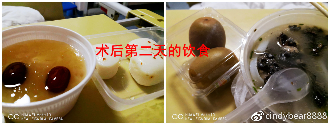 动画演示子宫全切手术,子宫附件全切术动画