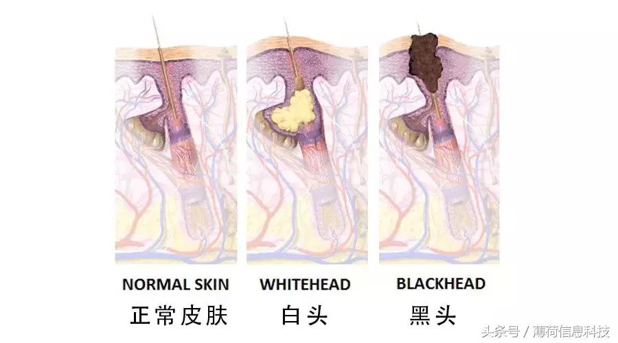 看完这篇，痘痘黑头通通灭掉