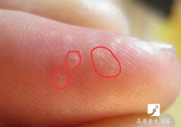 手上长水泡非常痒别抓这样处理,手上起小水泡很痒有什么土方法