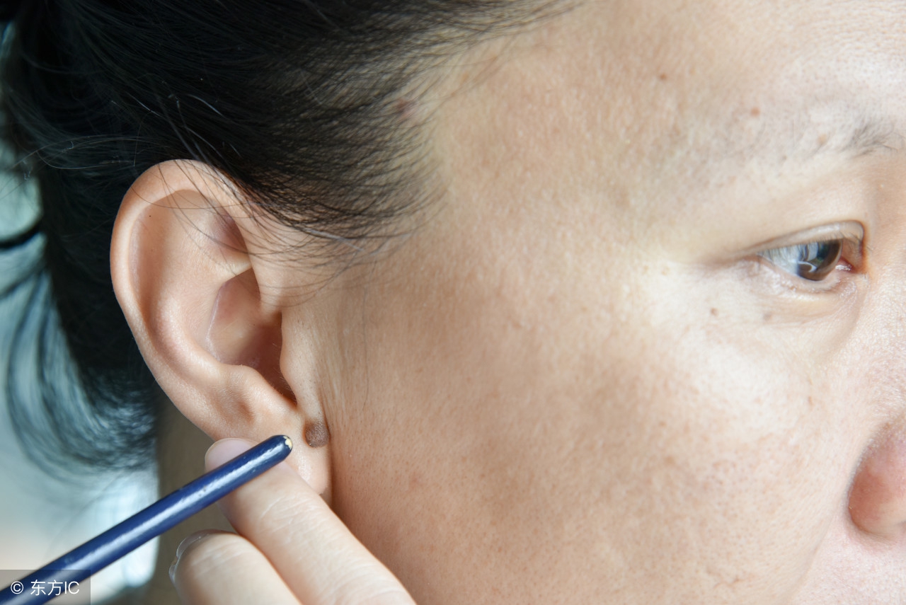 点痣膏点痣有什么危害,点痣需要注意什么才安全