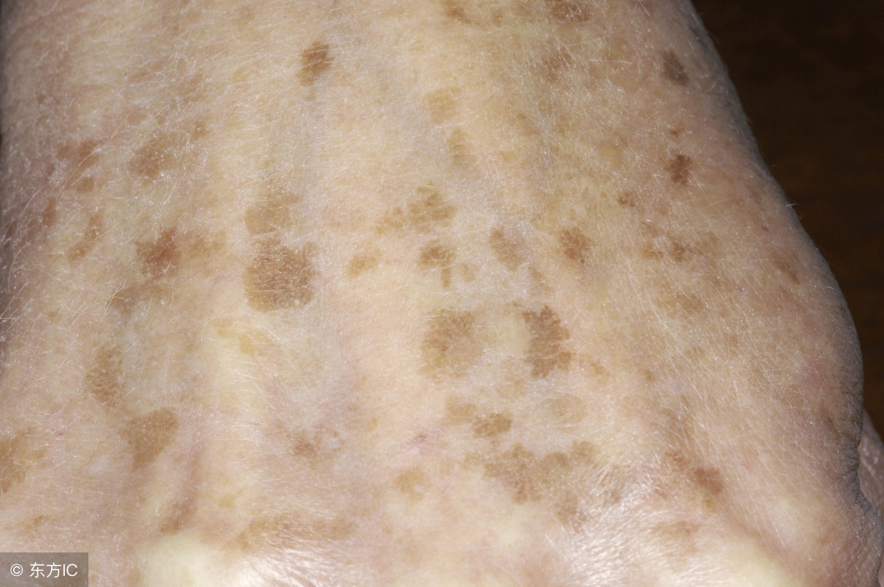 如何解决老年斑的根本原因,长老年斑的原因以及解决方案
