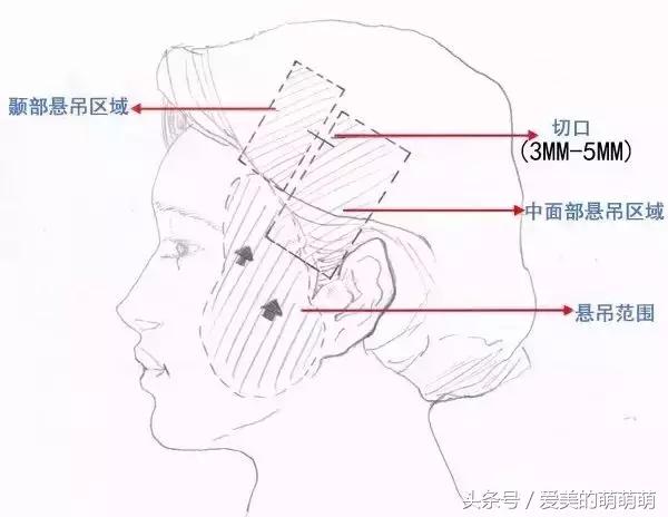 线雕悬吊术，逆生长就是这么随意！
