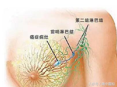 肿瘤最有可能长的地方在哪,肿瘤细胞在体内