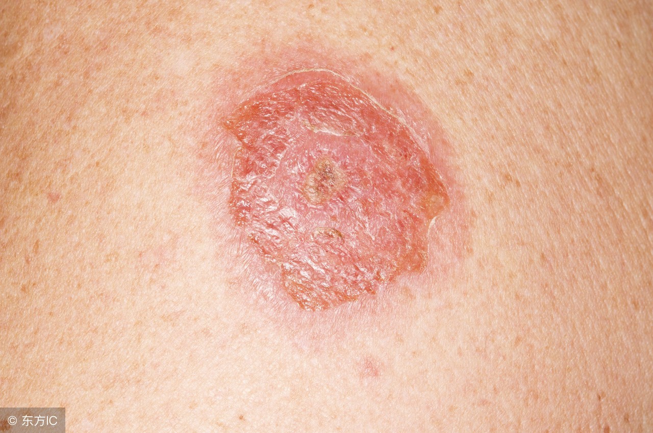 尖锐性湿疣如何预防传染,尖锐性湿疣怎样防止传染